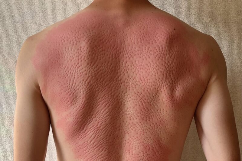 シャクティマット使用後の背中。突起の跡が赤く残っている